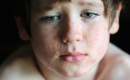 Boy with a classic childhood rash known as an Exanthem.
