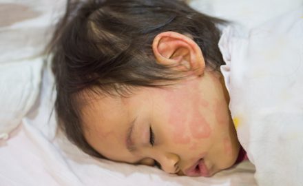 Child with red blotches on the face. Could this be Cold Urticaria?