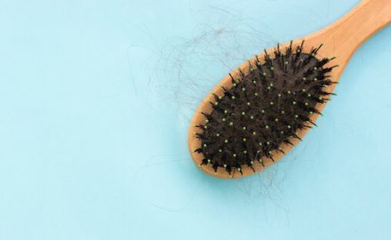 Hair loss -- hair brush filled with hair.