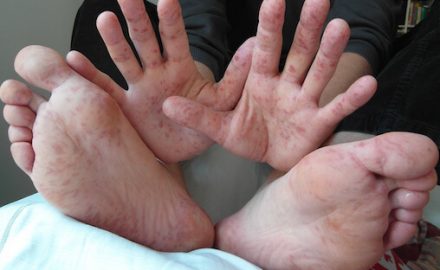 Is hand foot and mouth disease contagious? Hands and feet showing Hand-foot-and-mouth disease.