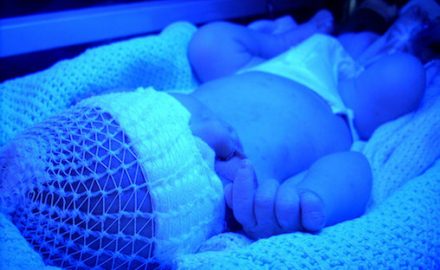 Baby being treated for jaundice with phototherapy.