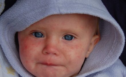 Baby with measles on his face. Measles vaccine .