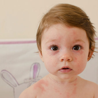 Roseola (Sixth Disease) Symptoms & Causes