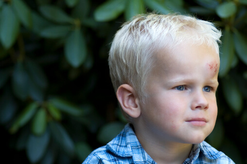 Child hits their head such as this young boy with swollen forehead after a fall