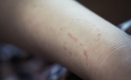 Human bite mark on an adult arm. Biting is normal for kids, but it is not desirable behavior.